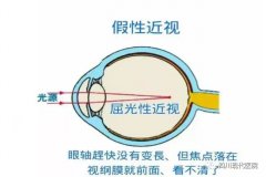 如(rú)何區分真性近視和(hé)“假性近視”呢(ne)?