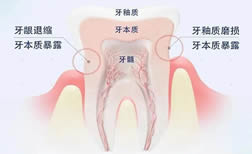 導緻牙本質敏感的因素有哪些？