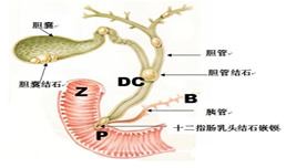 膽囊結石