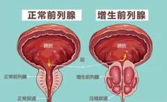 不良習慣對前列腺增生的影響