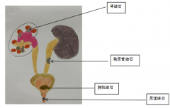 天熱謹防泌尿結石病高發